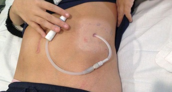 Peritonealna dializa danes še vedno podcenjena metoda zdravljenja končne ledvične odpovedi