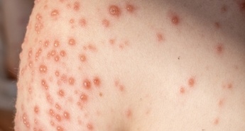 Norice: Cepljeni otroci niso zboleli